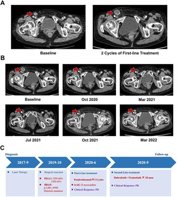 BRAF L485–P490 deletion mutant metastatic melanoma sensitive to BRAF and MEK inhibition: A case report and literature review